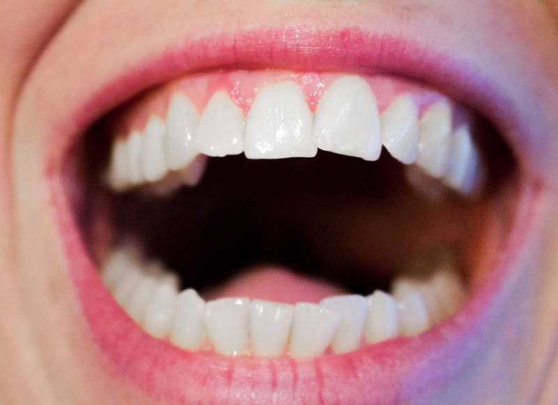 戴牙套纠正牙齿有哪些注意事项戴牙套纠正牙齿有用吗