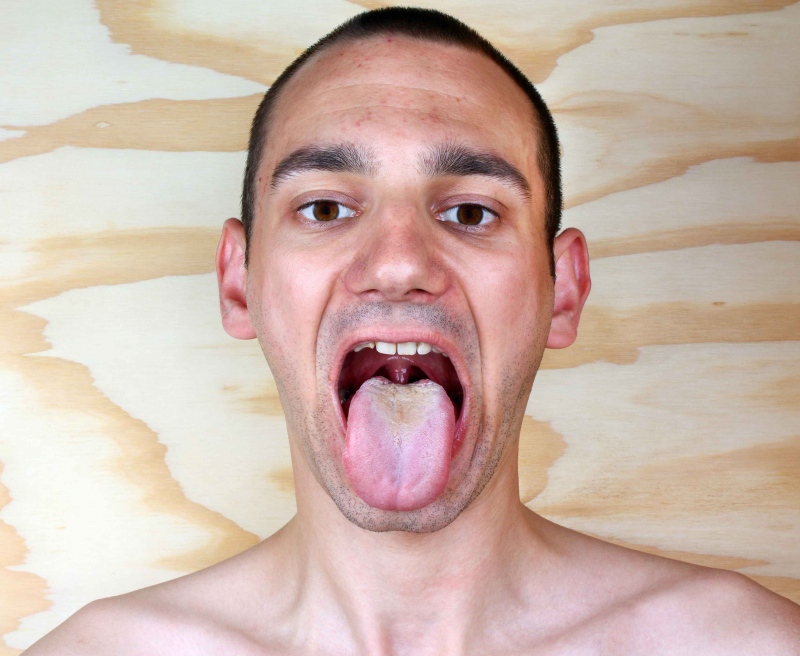 舌头发麻是怎么回事舌头发麻有哪些治疗方法